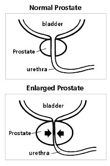 Diagram: Normal prostate versus enlarged prostate. BPH symptoms: Difficulty starting or stopping urination; Frequent need to urinate; Need to urinate in the middle of the night; Pain with urination; Weak or unsteady urine stream; Urine leakage (incontinence); Feeling as if the bladder is not completely empty after urination; Pain in and around the base of the penis or discomfort between the scrotum and rectum; Pus, blood, or cloudiness in the urine; Painful ejaculation; Difficulty having an erection; Pain in the lower back, hips, or upper thighs.